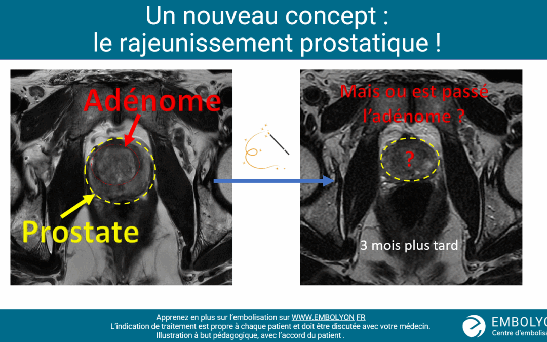 Rajeunissement prostatique